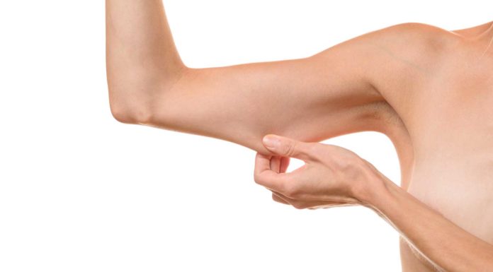Lipo-lifting des bras avec ThermiTIGHT sans chirurgie