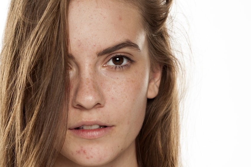 Que faire pour venir à bout des imperfections cutanées ?