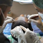 la greffe de cheveux pour éviter les conséquences psychologiques